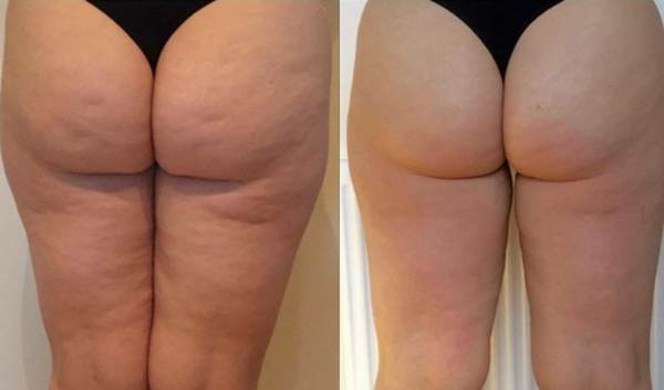 Cellulite